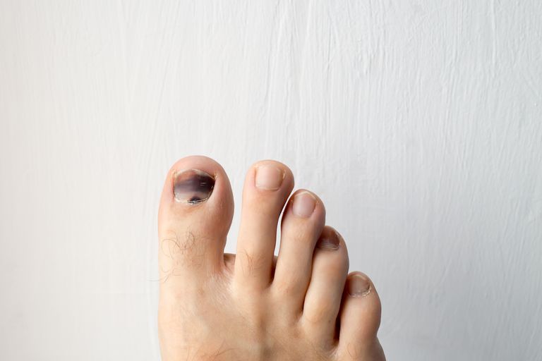 bruised nail