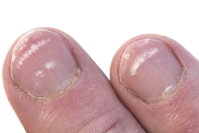 white toenails
