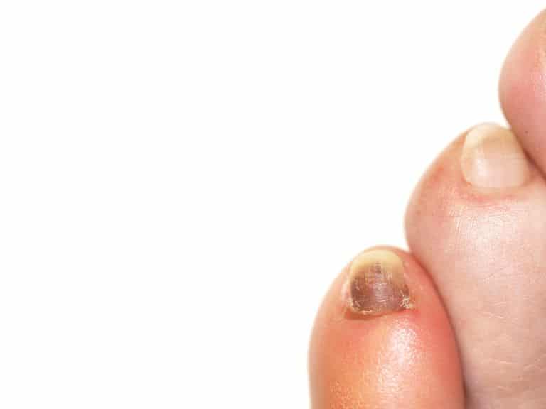 purple toes
